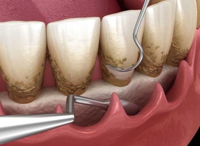 Removing tartar from below the gum line during a deep cleaning