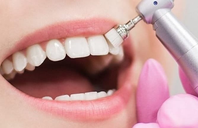 Polishing the front teeth during a dental cleaning