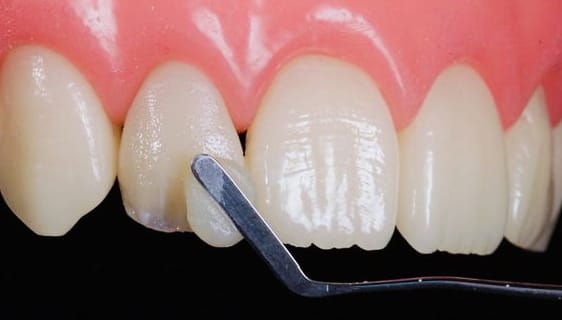 A tooth restored with a tooth-coloured filling