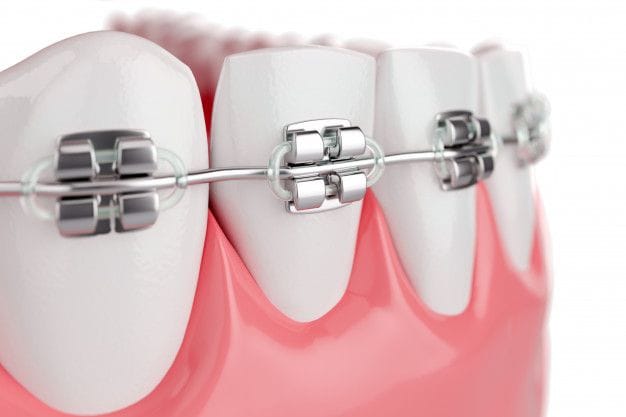 Braces fitted on the upper and lower teeth