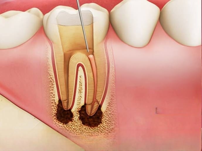A previously treated tooth being reopened for root canal retreatment