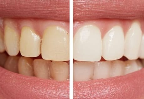 Comparing tooth shade during a professional whitening treatment